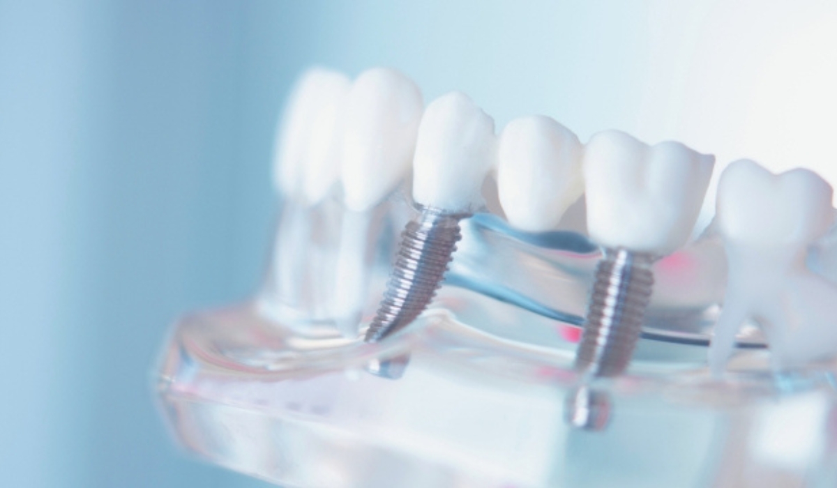 Prikaz zubnih implantata