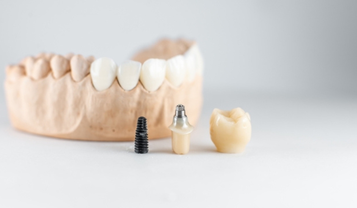 Zubni implantat sa krunicom, kao i delove potrebne za njegovu ugradnju