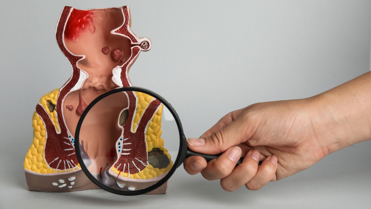 Medicinski model prikazuje spoljašnje hemoroide tokom pregleda i objašnjenja simptoma